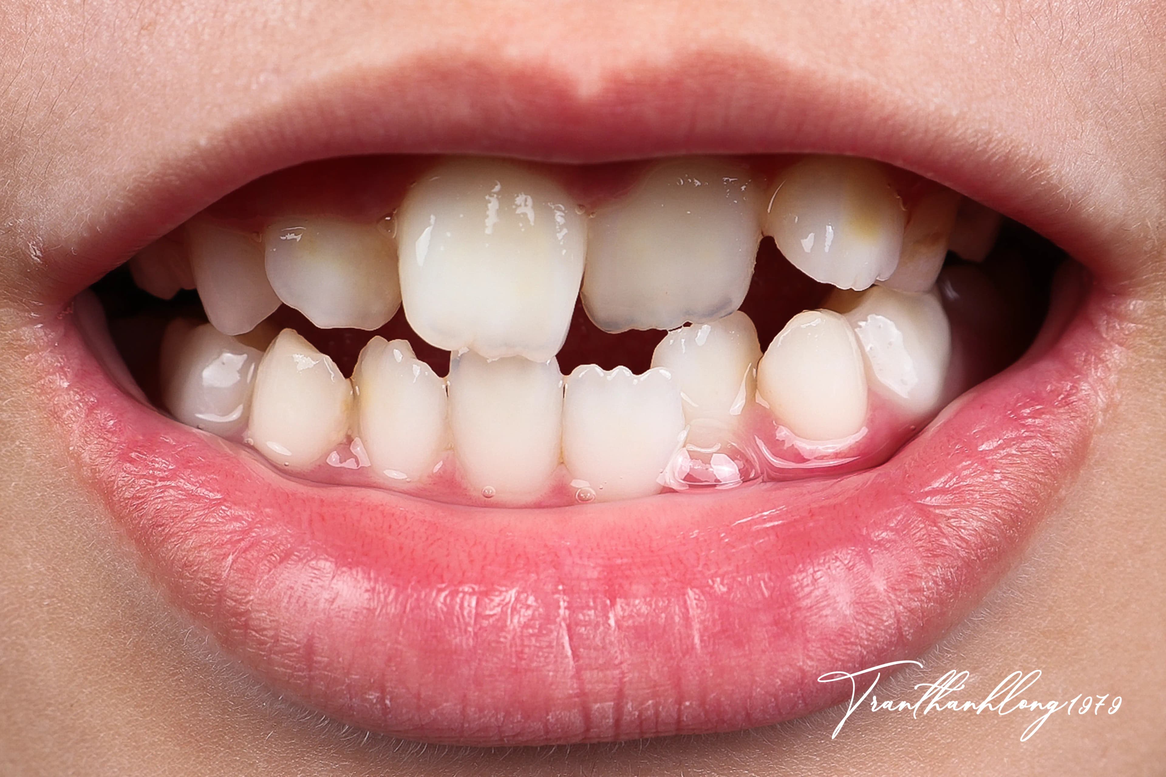 Kết quả điều trị của 002120925 - Before