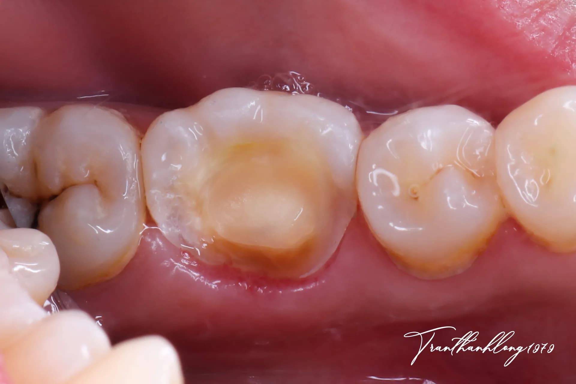 Kết quả điều trị của 004060825 - Before