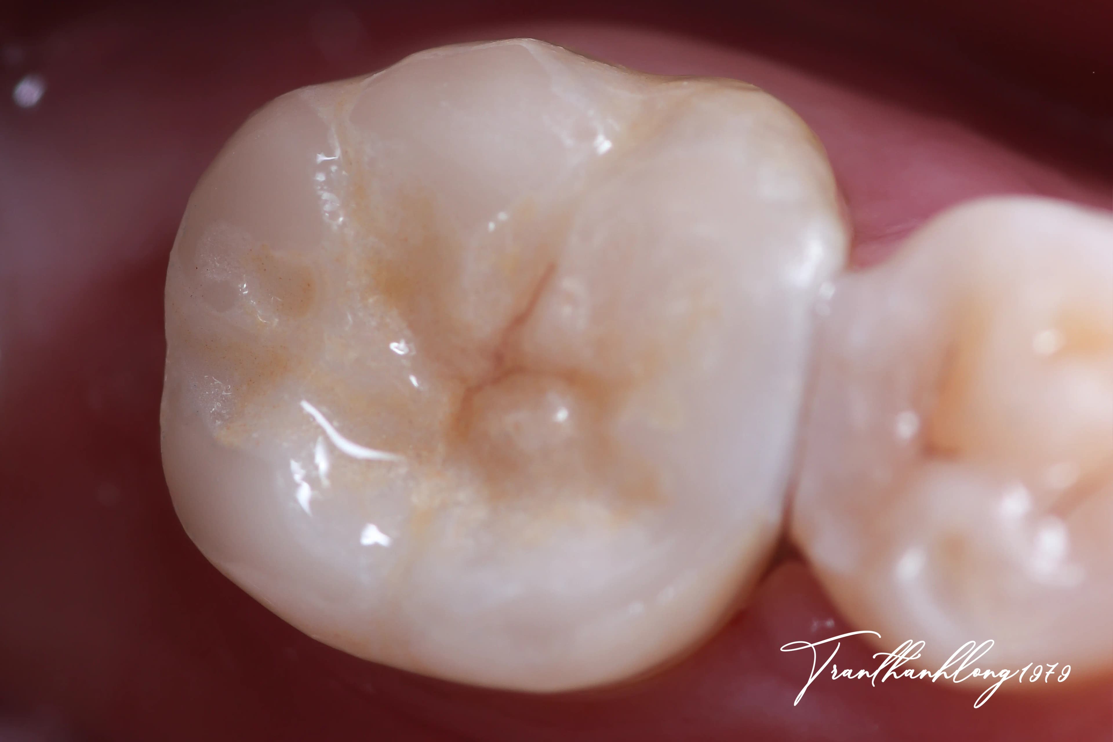 Kết quả điều trị của 001220723 - After