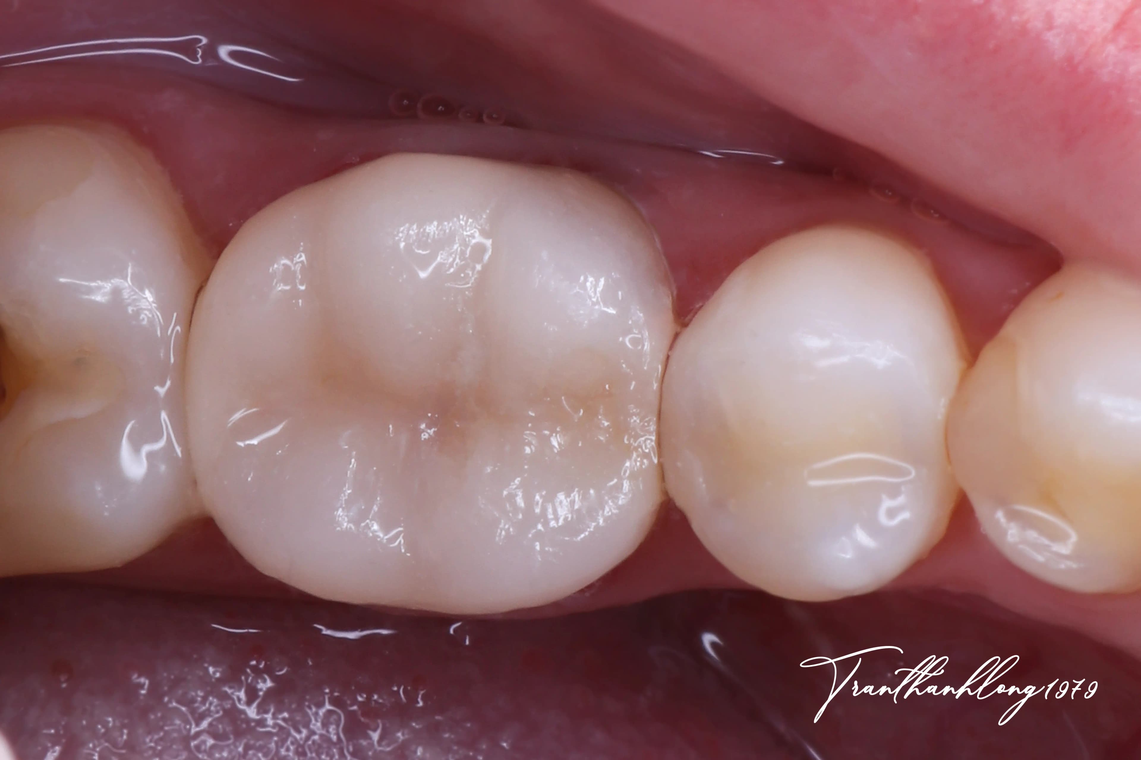 Kết quả điều trị của 005090123 - After