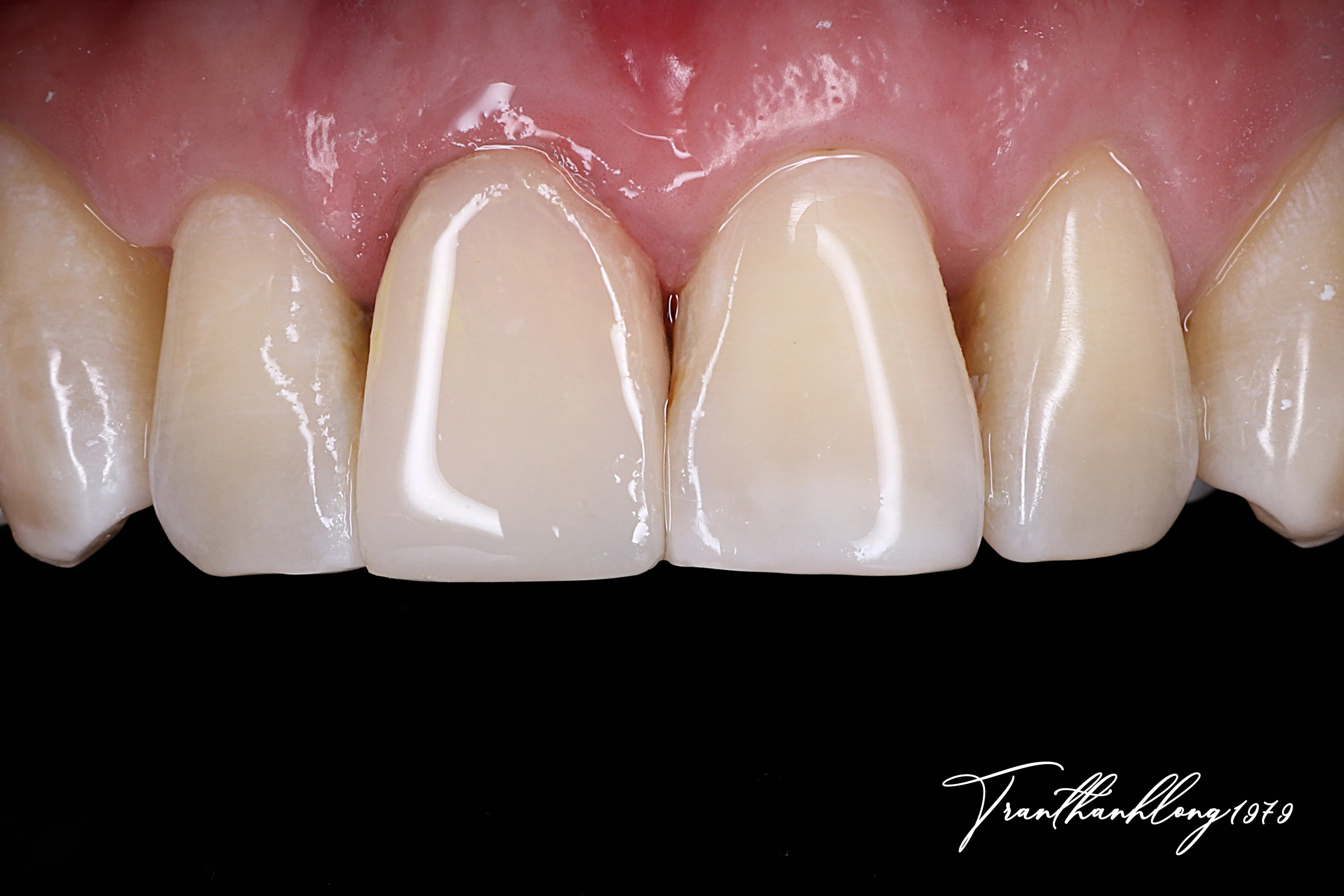 Kết quả điều trị của 011301224 - After