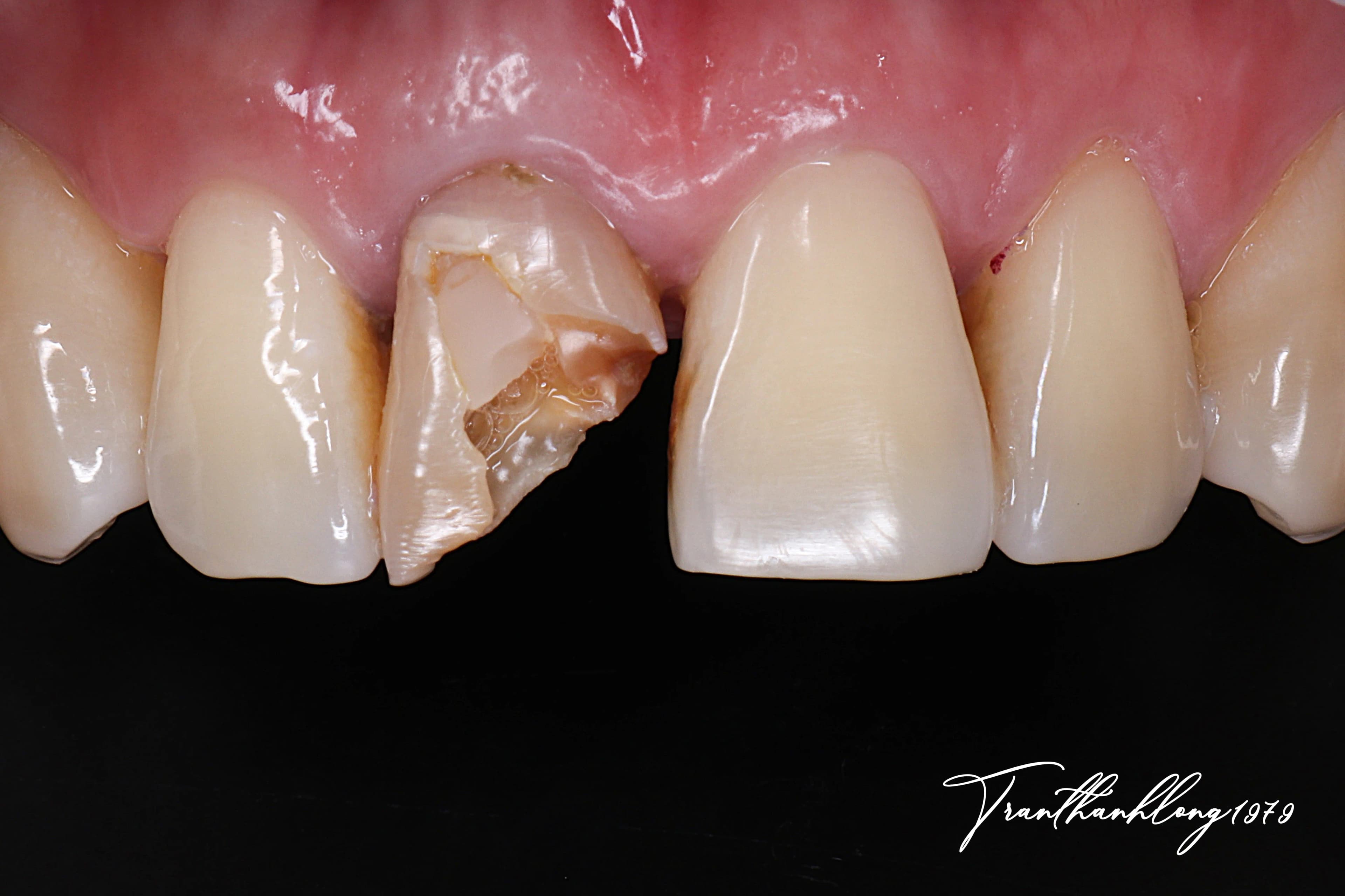 Kết quả điều trị của 011301224 - Before