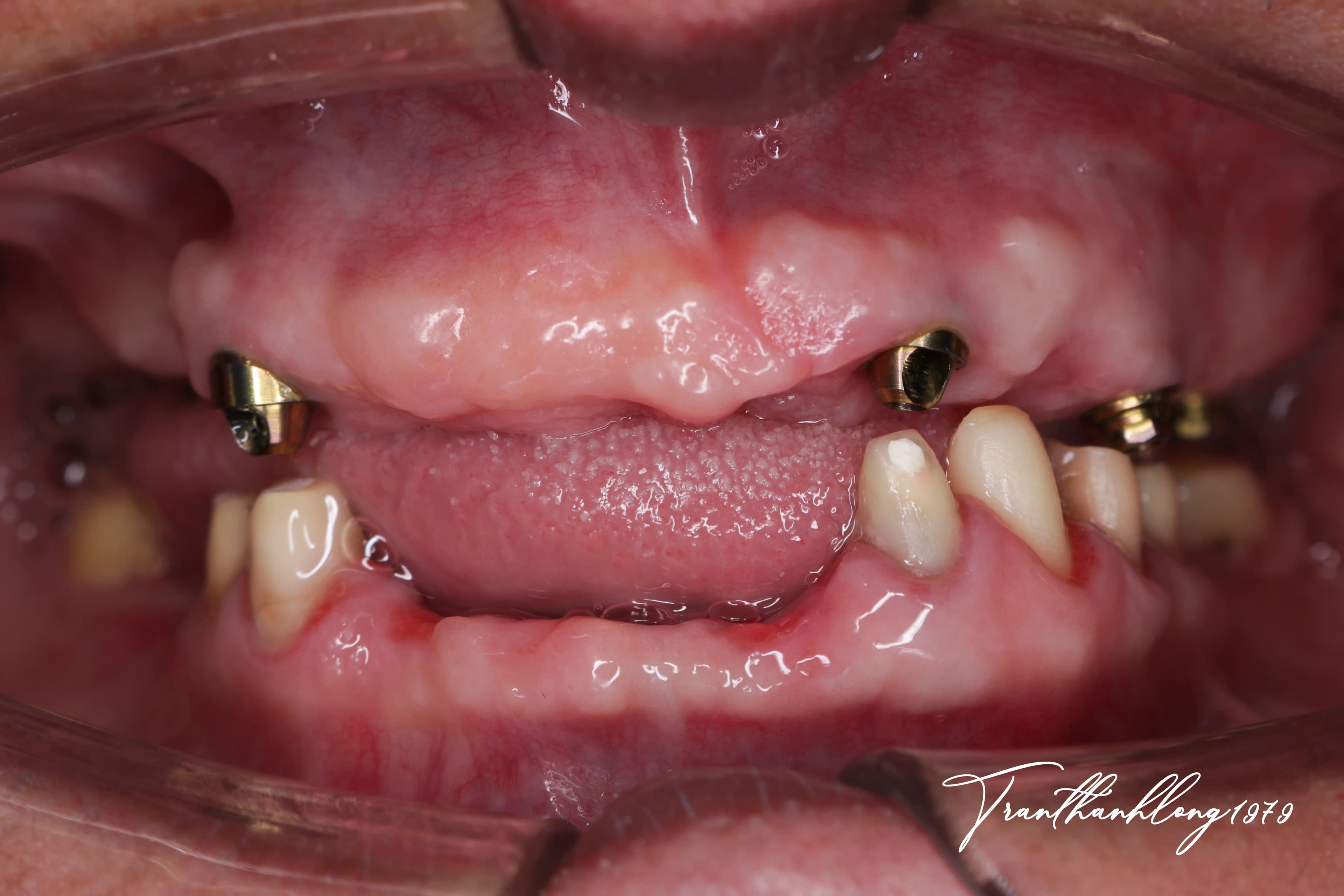 Kết quả điều trị của 001220922 - Before