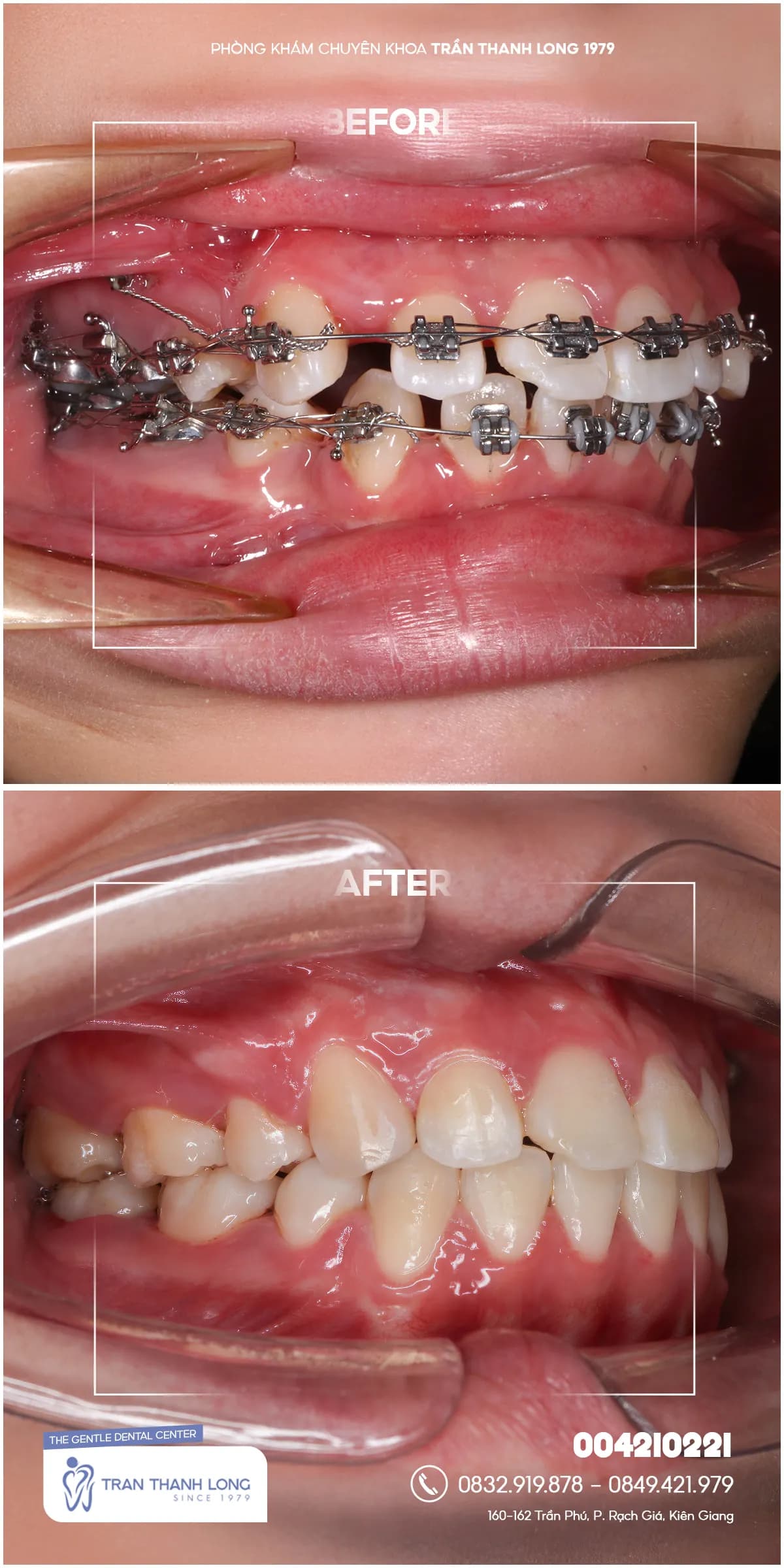 Hình ảnh quá trình điều trị 1