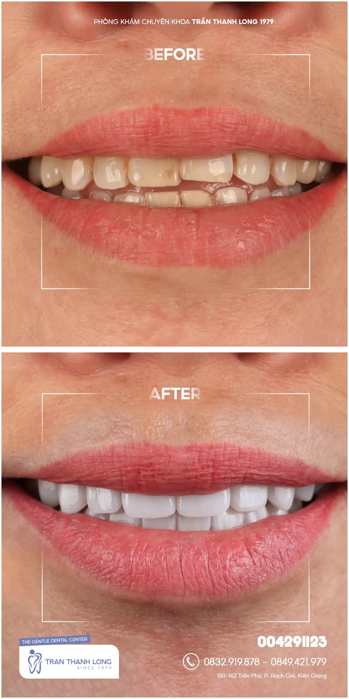 Hình ảnh quá trình điều trị 1