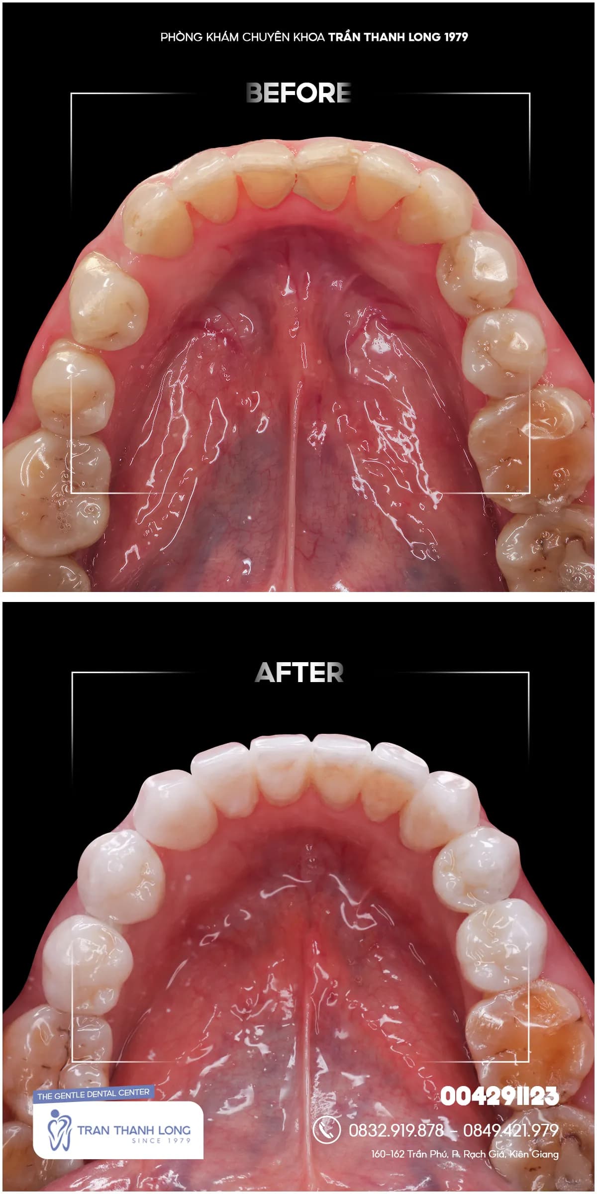 Hình ảnh quá trình điều trị 3