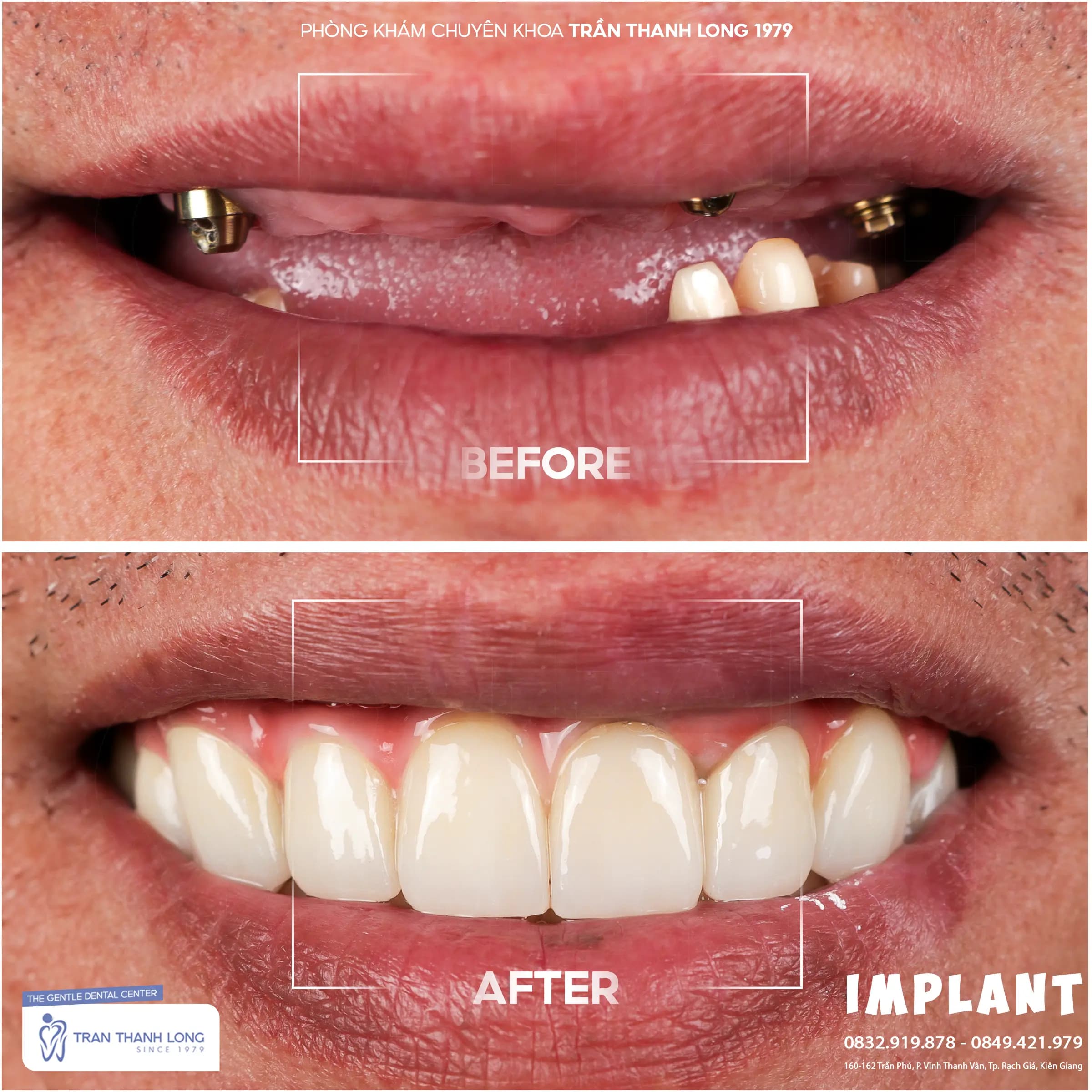 Hình ảnh quá trình điều trị 1