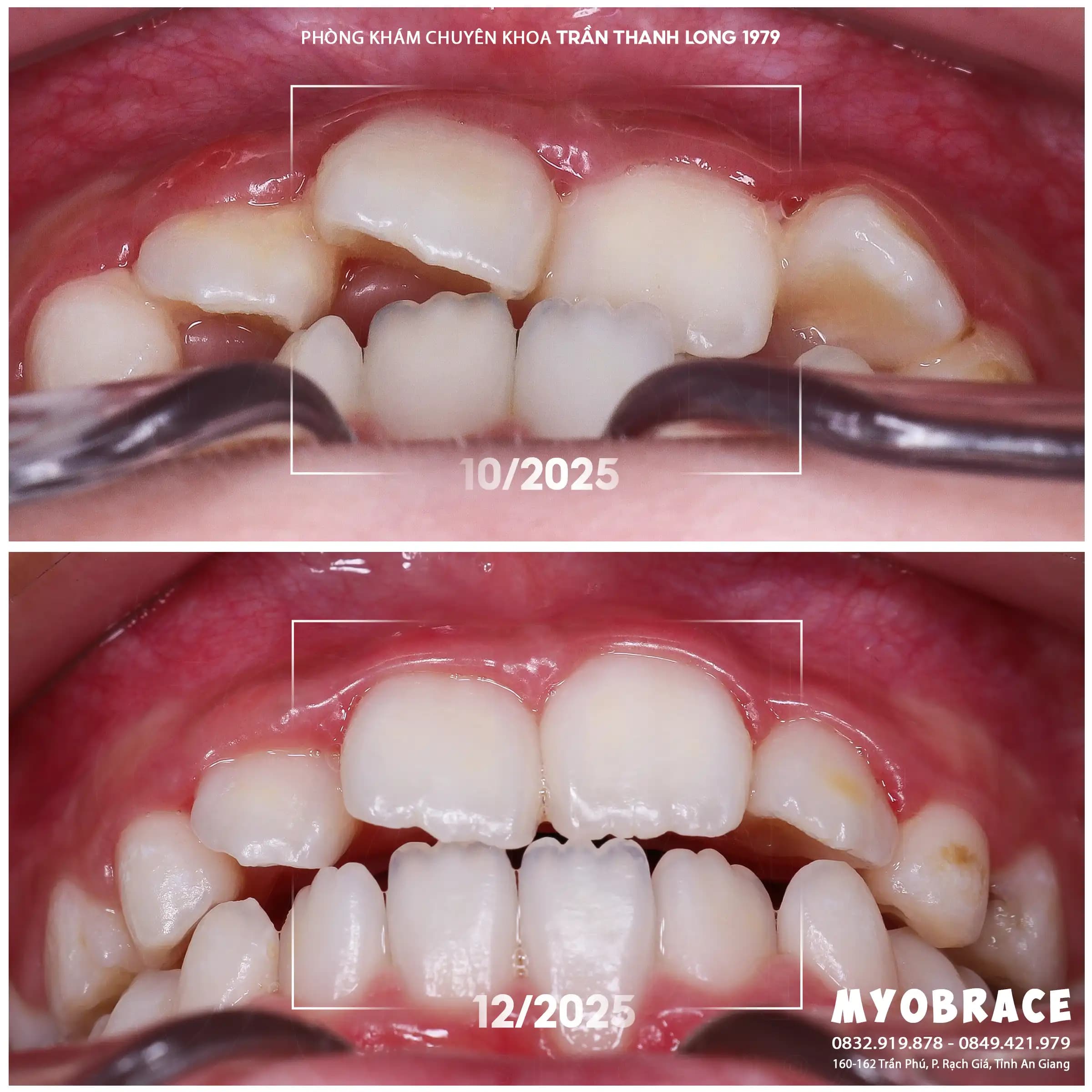 Hình ảnh quá trình điều trị 2